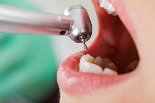 Best Emergency Dentist for Lost Fillings or Crowns in Sisseton, SD